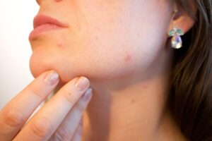 Vaiolo delle scimmie: rischio epidemia se ignorato
