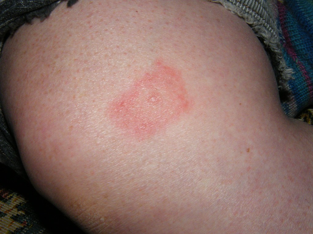 Malattia di Lyme: cos’è e come prevenirla Malattia di Lyme: cos’è e come prevenirla
