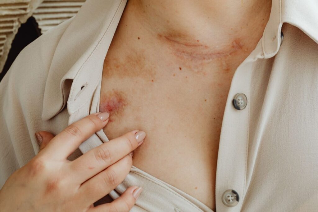 Dermatite atopica: cosa succede davvero alla pelle e perché non va sottovalutata Dermatite atopica: cosa succede davvero alla pelle e perché non va sottovalutata