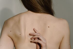 Vaccino personalizzato contro il melanoma: la svolta dell’mRNA che apre una nuova era in oncologia