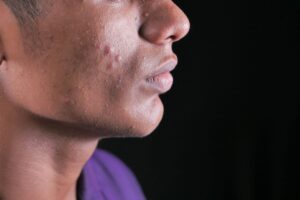 Mpox (vaiolo delle scimmie): cos’è, come si trasmette, sintomi, cure e vaccino