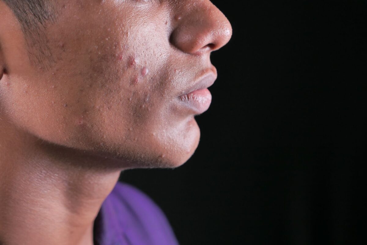 Mpox (vaiolo delle scimmie): cos’è, come si trasmette, sintomi, cure e vaccino